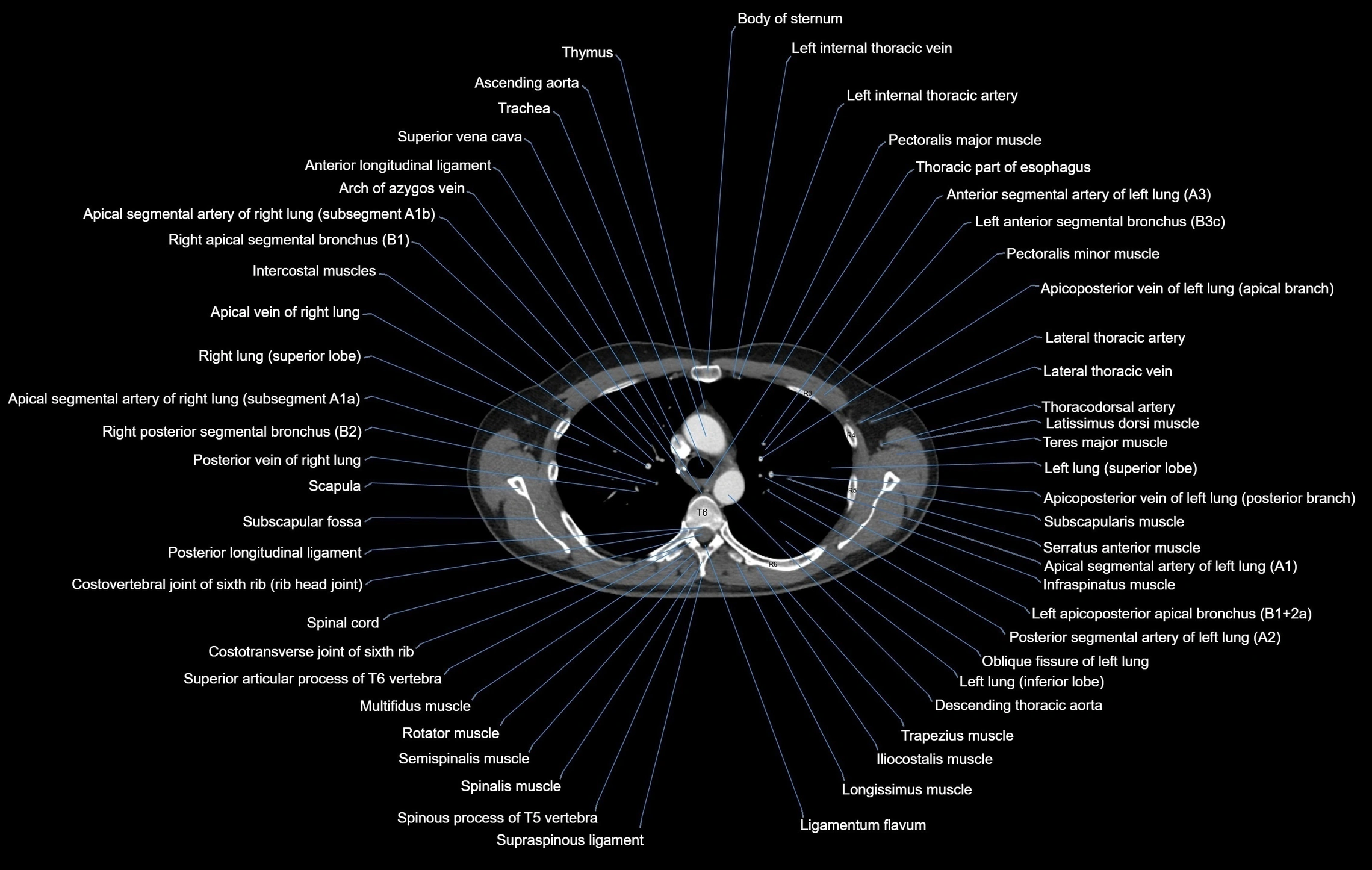 CT chest (thorax) labelled axial cross sectional anatomy radiology image-00042.webp